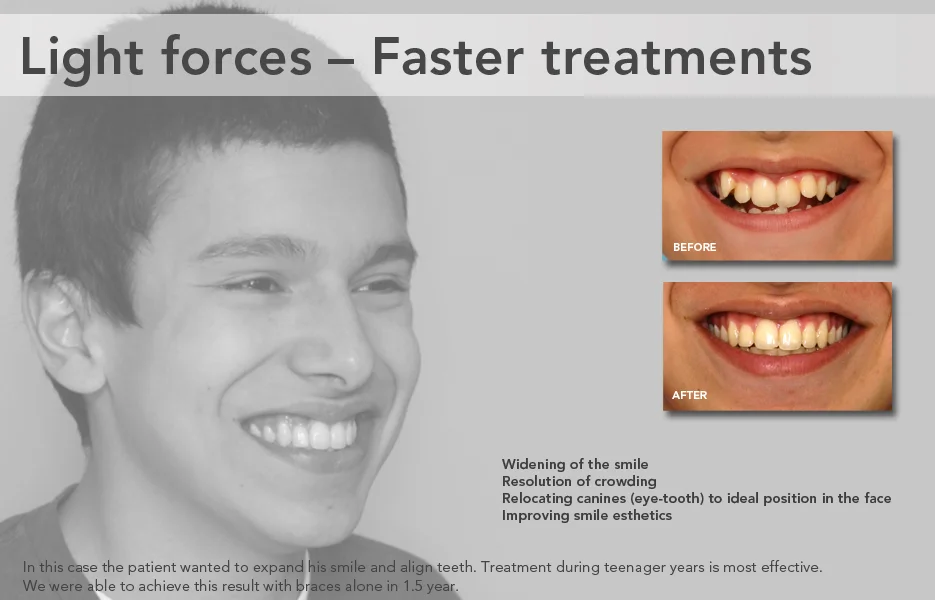 Improving Smile Esthetics with Hidden Braces at Grauer Smiles, Los Angeles, California