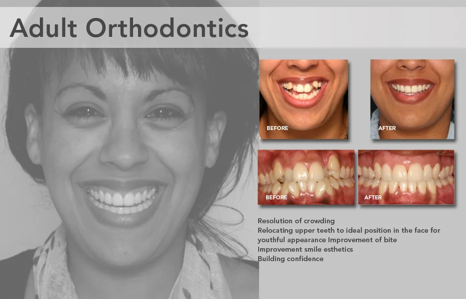 Improving Smile Esthetics with Hidden Braces at Grauer Orthodontics, Los Angeles, California