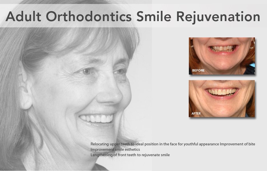 Improving Smile Esthetics with Hidden Braces at Grauer Orthodontics, Los Angeles, California